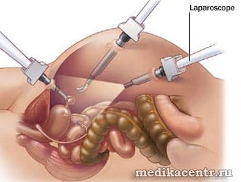Ход процедуры лапароскопии