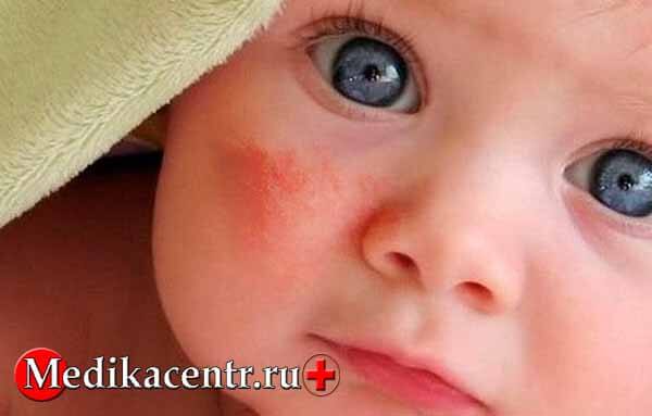 Аллергия у новорождённых