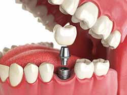 достоинства и недостатки нейлоновых зубных протезов