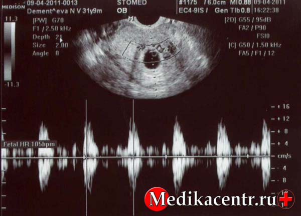 Как прослушать сердцебиение на 9 неделе беременности