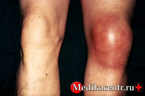 Симптомы супрапателлярного бурсита коленного сустава
