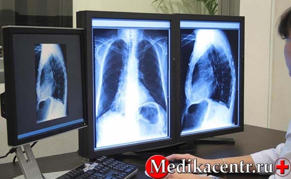 Какие исследования проходят для постановки диагноза «туберкулёз»