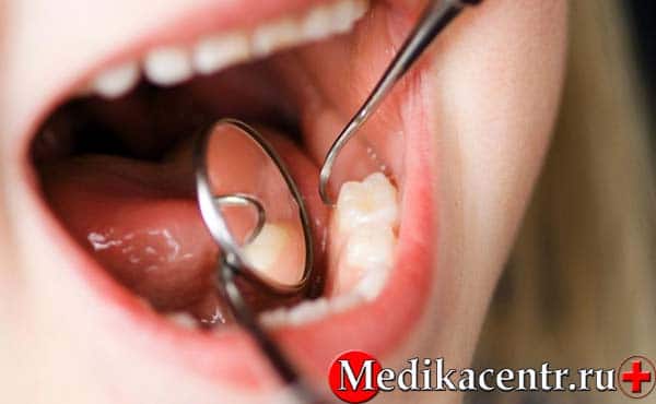 В каких случаях показано удаление зуба