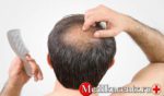Проблемы выпадения волос у мужчин