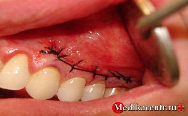 Лечение кисты на корне зуба