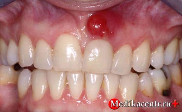 Причины возникновения кисты на корне зуба