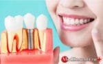 Возможные риски и осложнения после имплантации зубов